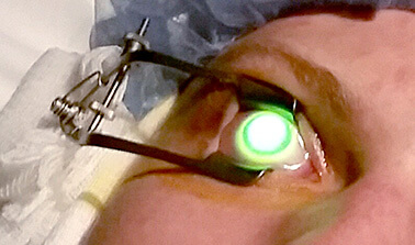 Corneal Crosslinking Patient Having Eye illuminated