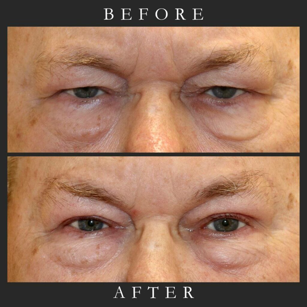 BULB & Brow Before and After