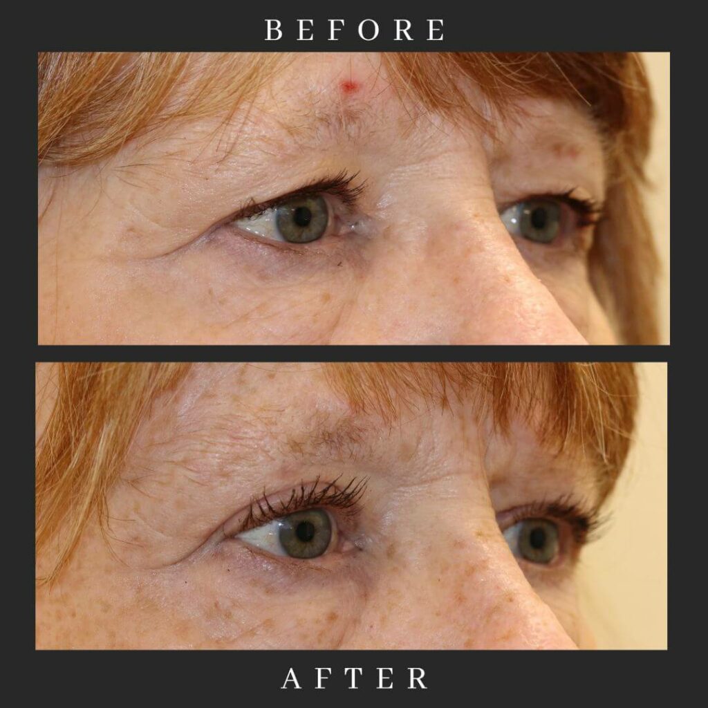 BULB on Right Eye Before and After