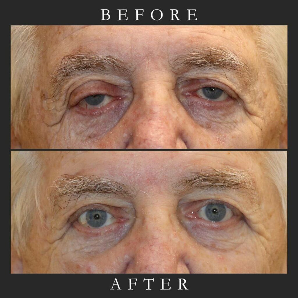 Dir Brow Ptosis Canthoplasty w Mid-face lift