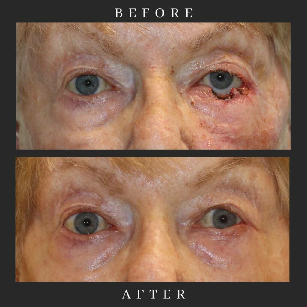 MOHS Reconstruction Before and After