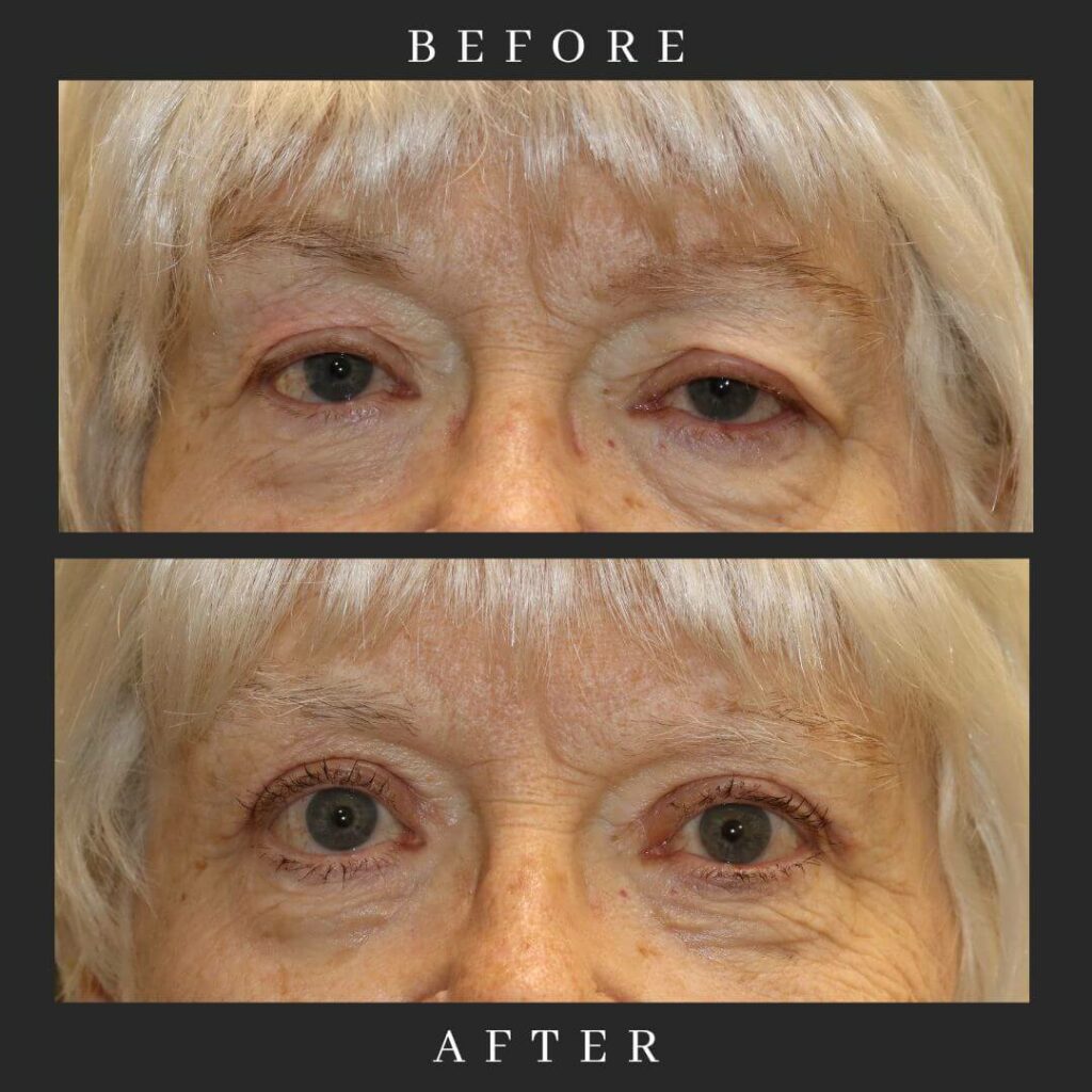 Ptosis & BULB Before and After