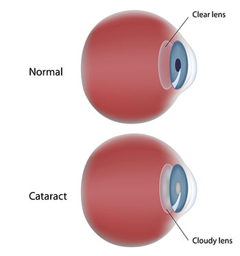 Chart showing a normal eye vs one with a cataract