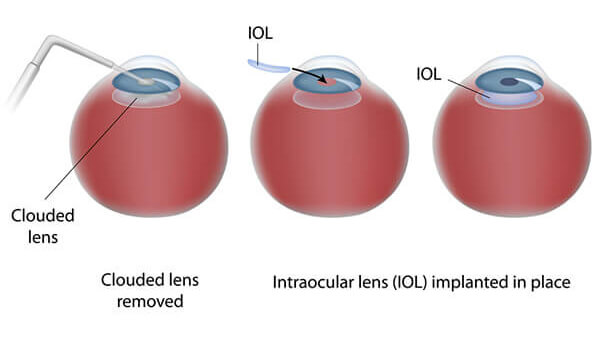 Chart showing the Cataract Surgery process