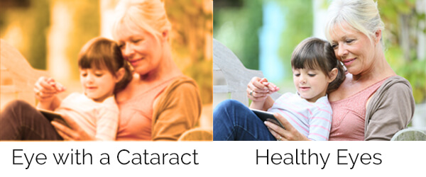 Chart showing what it's like to see with a cataract