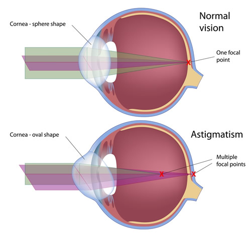 Chart Showing an Eye With Astigmatism