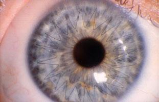 Closeup of an eye that had a corneal transplant