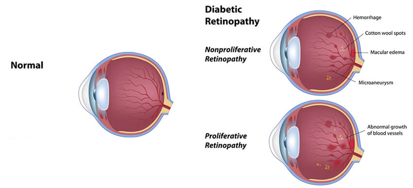 Chart Showing an Eye With Diabetic Retinopathy
