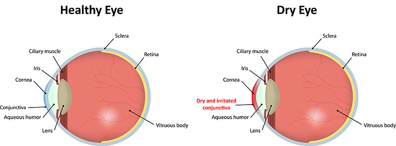 Chart showing a healthy eye vs a dry eye