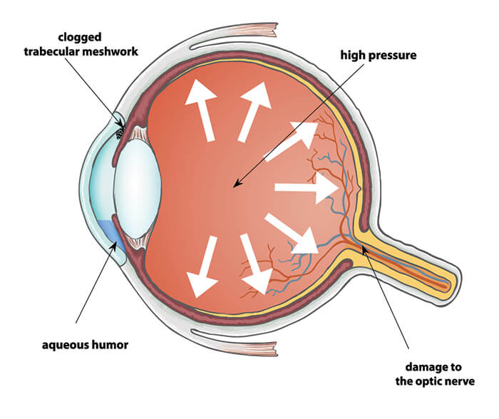 Chart showing what glaucoma does to the eye