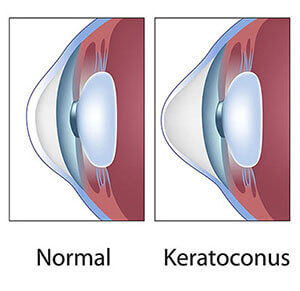 Chart showing Keratoconus in the eye