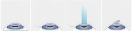 Chart showing the LASIK procedure