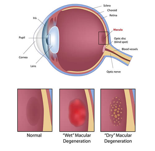 Chart Showing Macular Degeneration