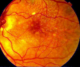 Scan showing macular degeneration in the eye